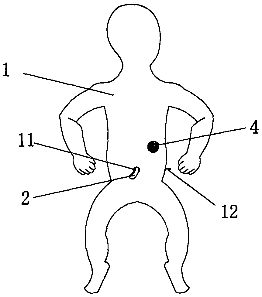 脐带结扎实训装置的制造方法附图