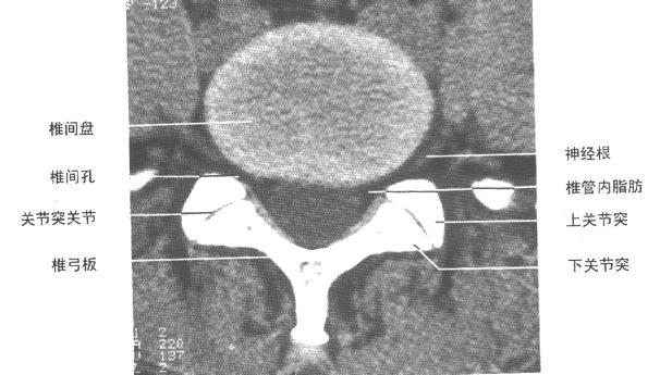 腰椎ct断层解剖图谱图片