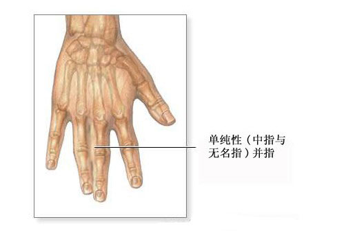 手指指蹼图解图片