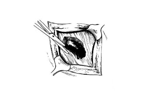 巴氏腺造口术缝针图片图片