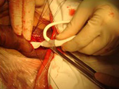 医学医药 医学图库阴茎假体适用于器质性阳痿如外伤,盆腔手术伤及阴部