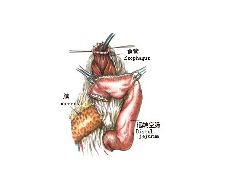 胃空肠吻合术示意图图片
