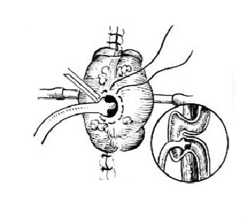 回肠双腔造瘘术图片