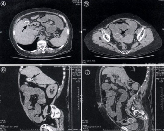 折叠胆囊ct图片图片