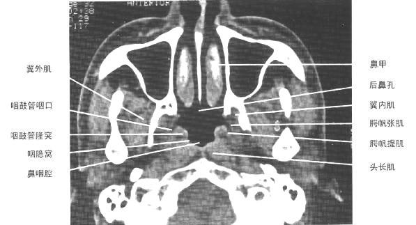 鼻骨断层解剖图片