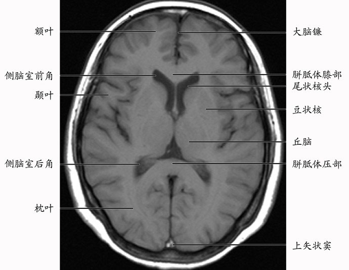 正常颅脑影像解剖图医学影像图