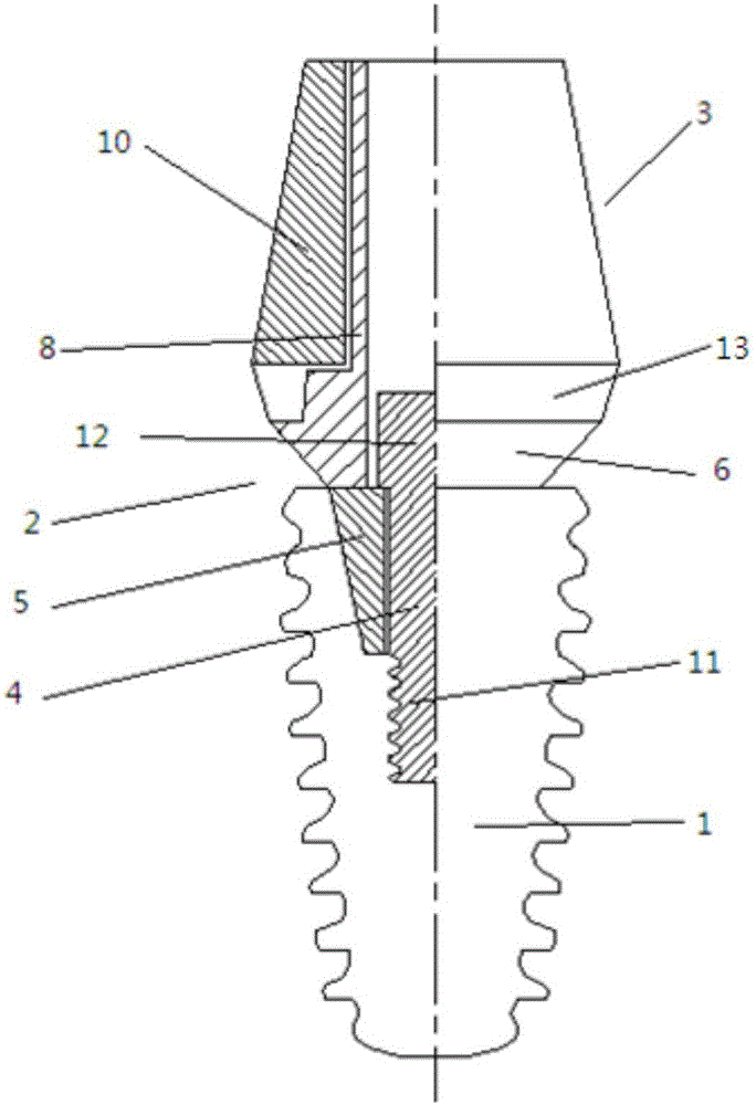 一种分体式种植牙构件的制作方法附图